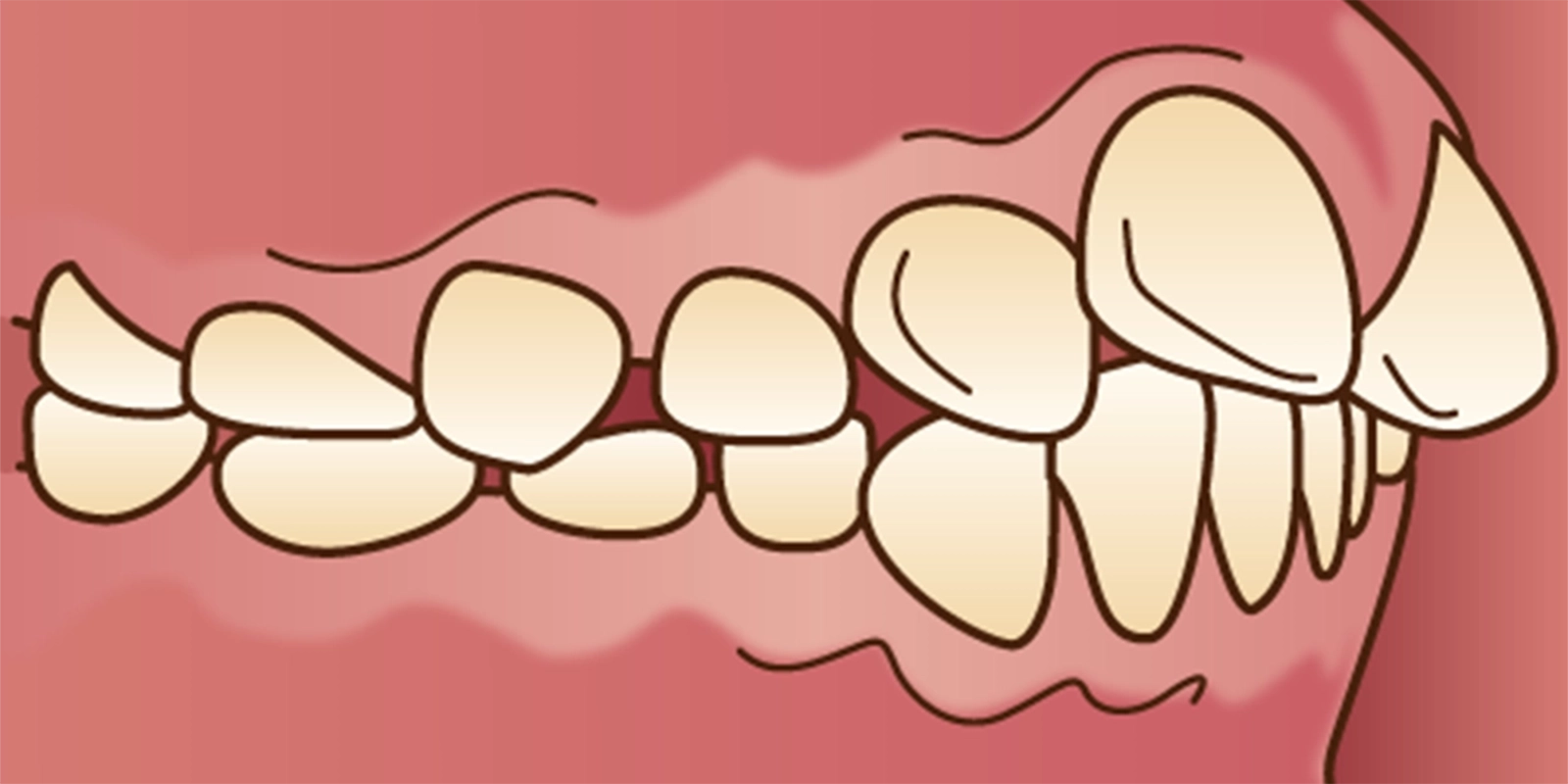 インビザラインで出っ歯は治る?