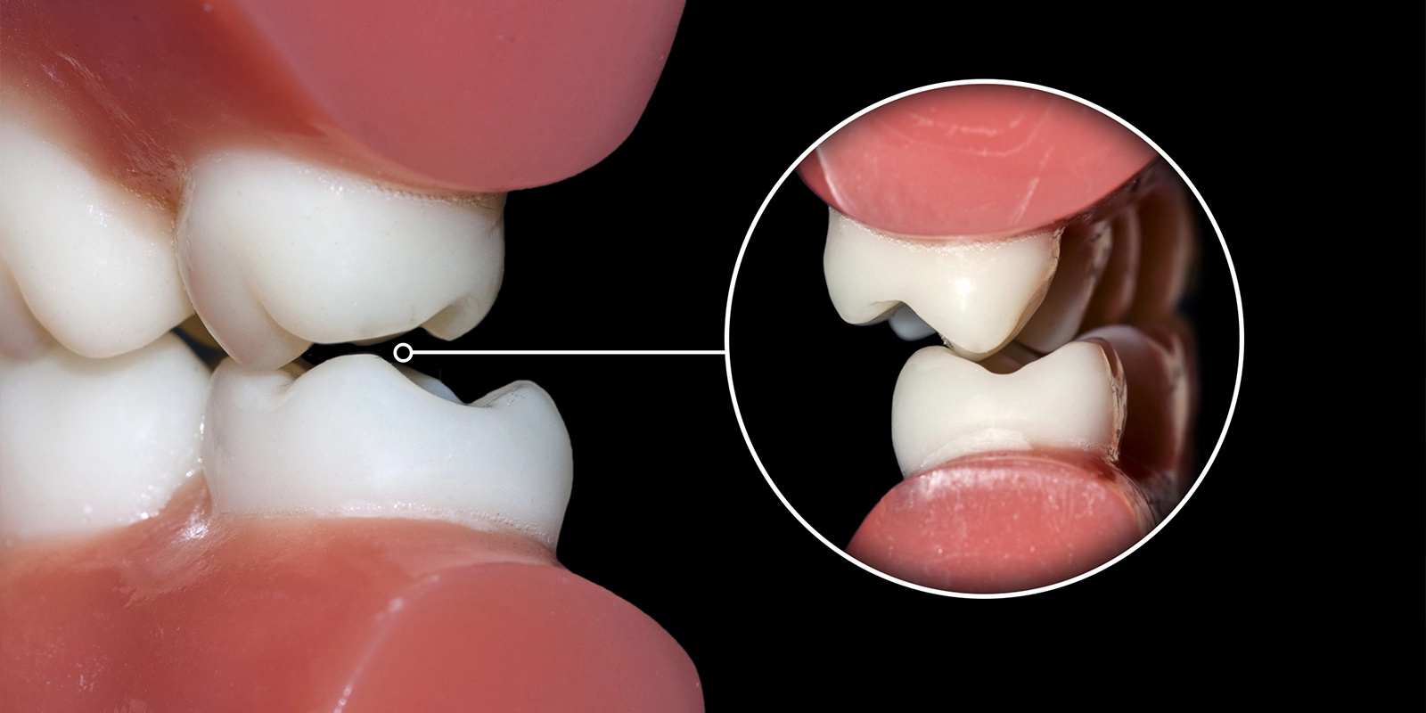 そもそも歯ぎしりとは