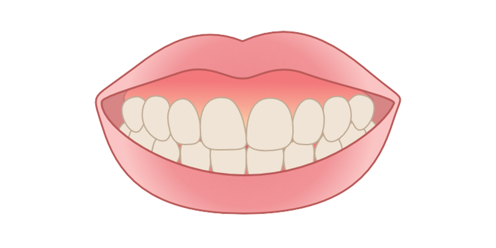 ガミースマイルとは